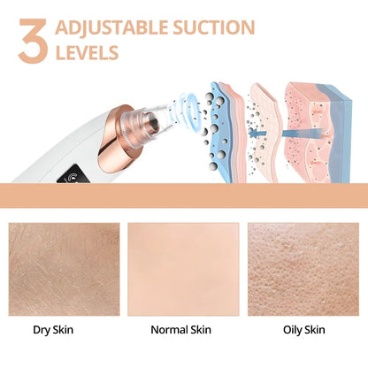 Portable Electric Blackhead Remover – Home Skincare Device